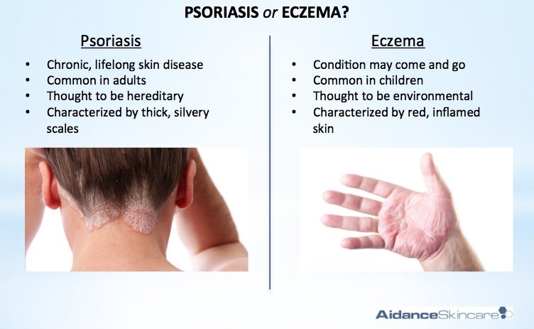Psoriasis Vs Eczema The Difference