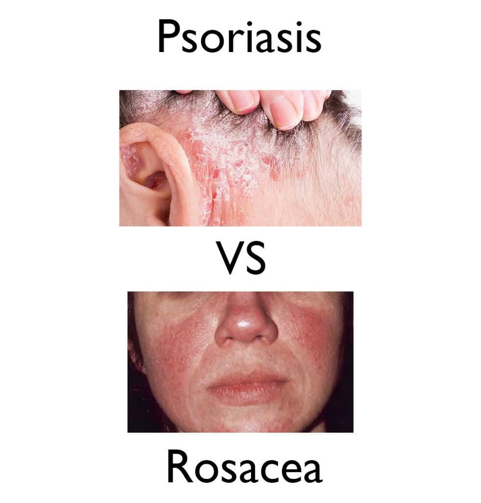 Psoriasis vs Rosacea? Do I Have Psoriasis or Rosacea? Discover the Truth
