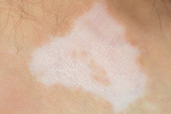 Psoriasis White Patches: What Happens to Your Skin During a Flare