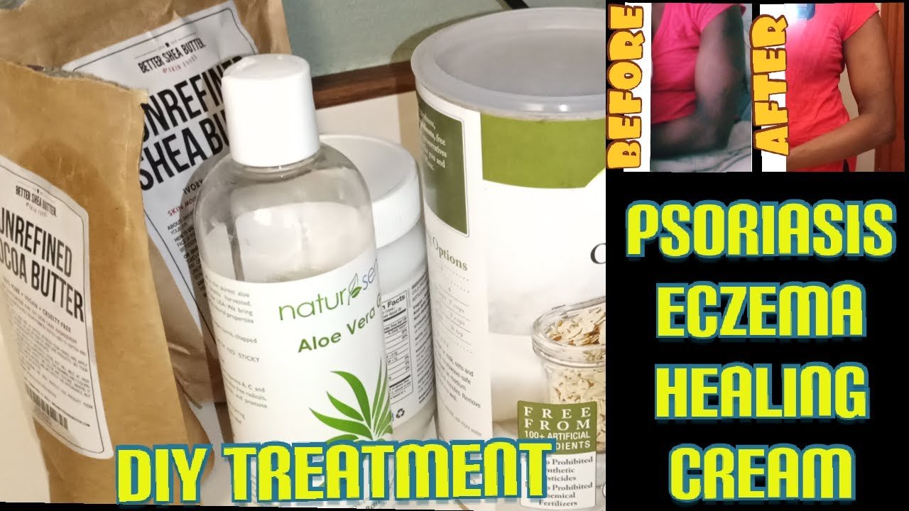 Psoriasis/Eczema Natural Remedies / Psoriasis/Eczema ...