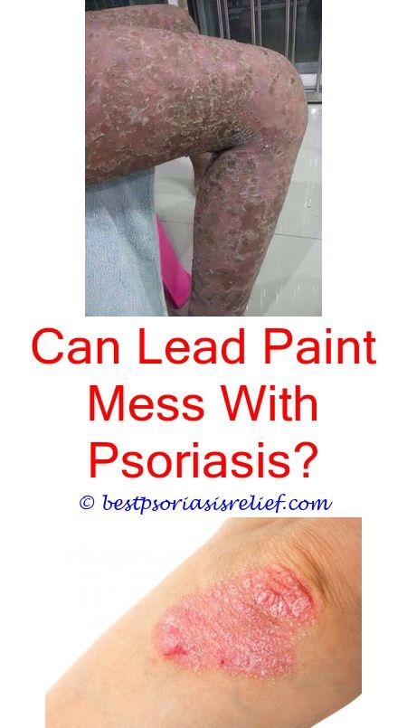 #psoriasispics how do you get rid of psoriasis