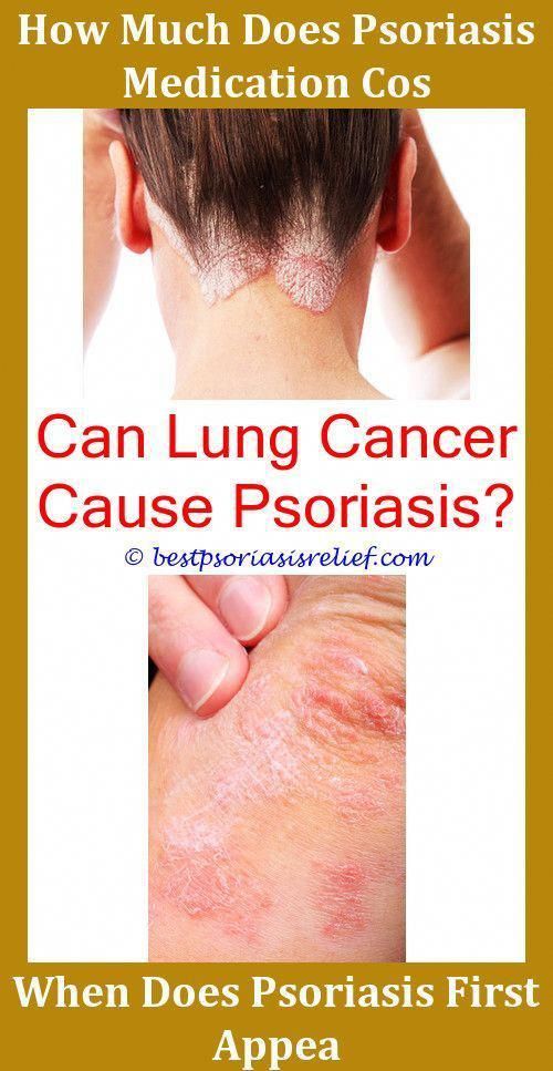 Psoriasistreatmentotc Psoriasis Eczema Or Dermatitis ...
