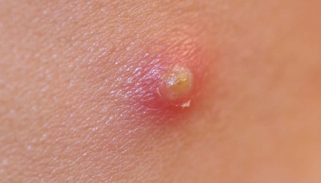 Pustule: Causes, treatments, and home remedies