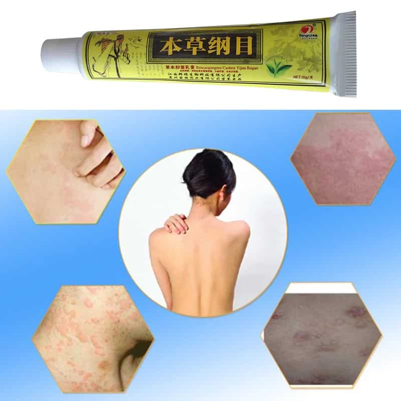QICAOGANGMU Focallure Skin Psoriasis Cream Dermatitis ...