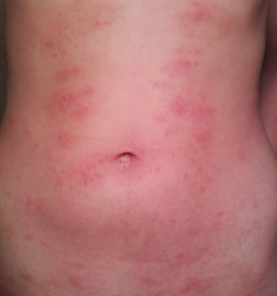 Rash All Over Body Except Face Doesnt Itch
