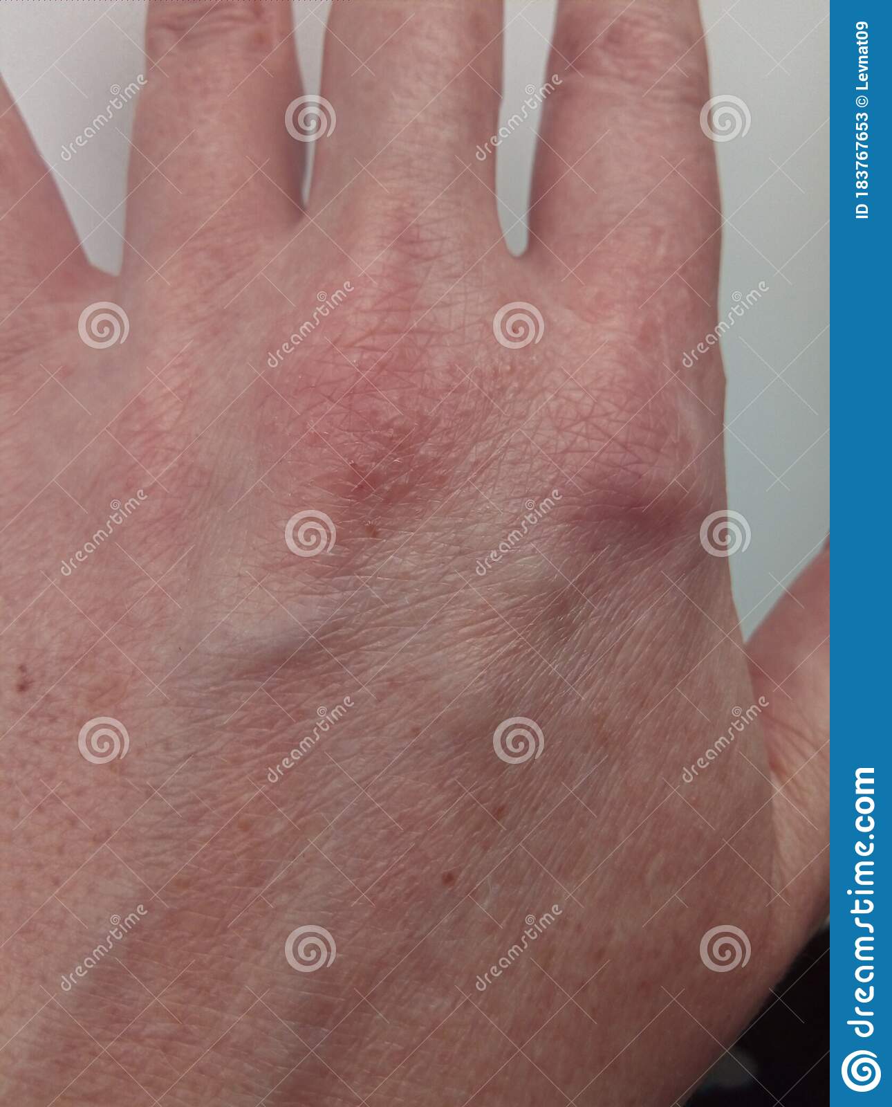 Rash and Hives on the Skin of the Back of the Female Hand, Allergic ...