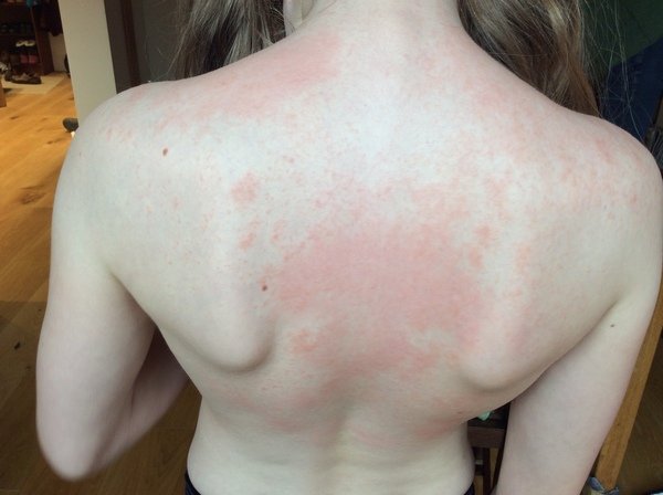Rash getting worse...allergy? Eczema? Virus? Photo to help ...