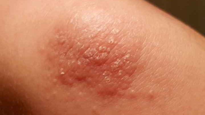 Rash on elbows: and Knees, Bumps, Arms, Eczema, How to Get Rid