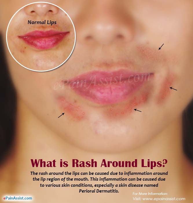 Rash On Lips Pictures