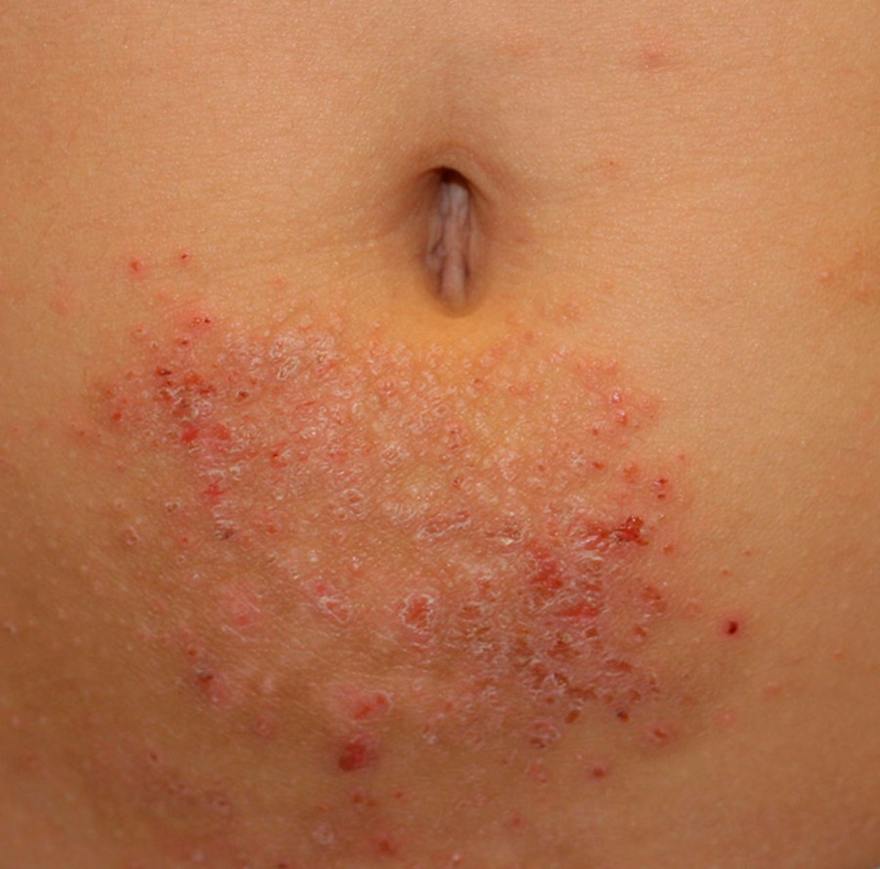 Rash on Stomach Causes, Pictures and Back, Breast, Groin ...