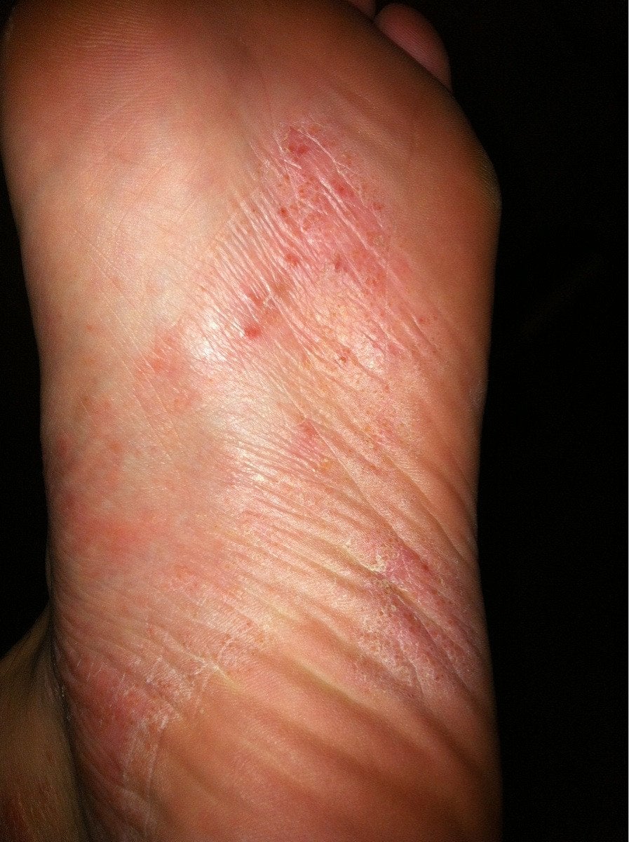 Rash/eczema on the soles of my feet? Started at the sides ...