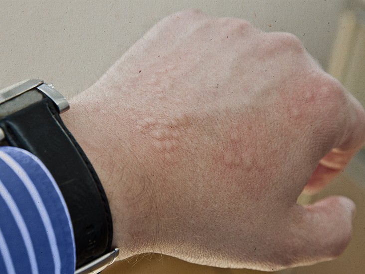 Rashes that look like scabies: Causes, symptoms, and treatment