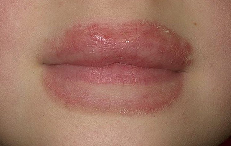 Red Around Lips Treatment
