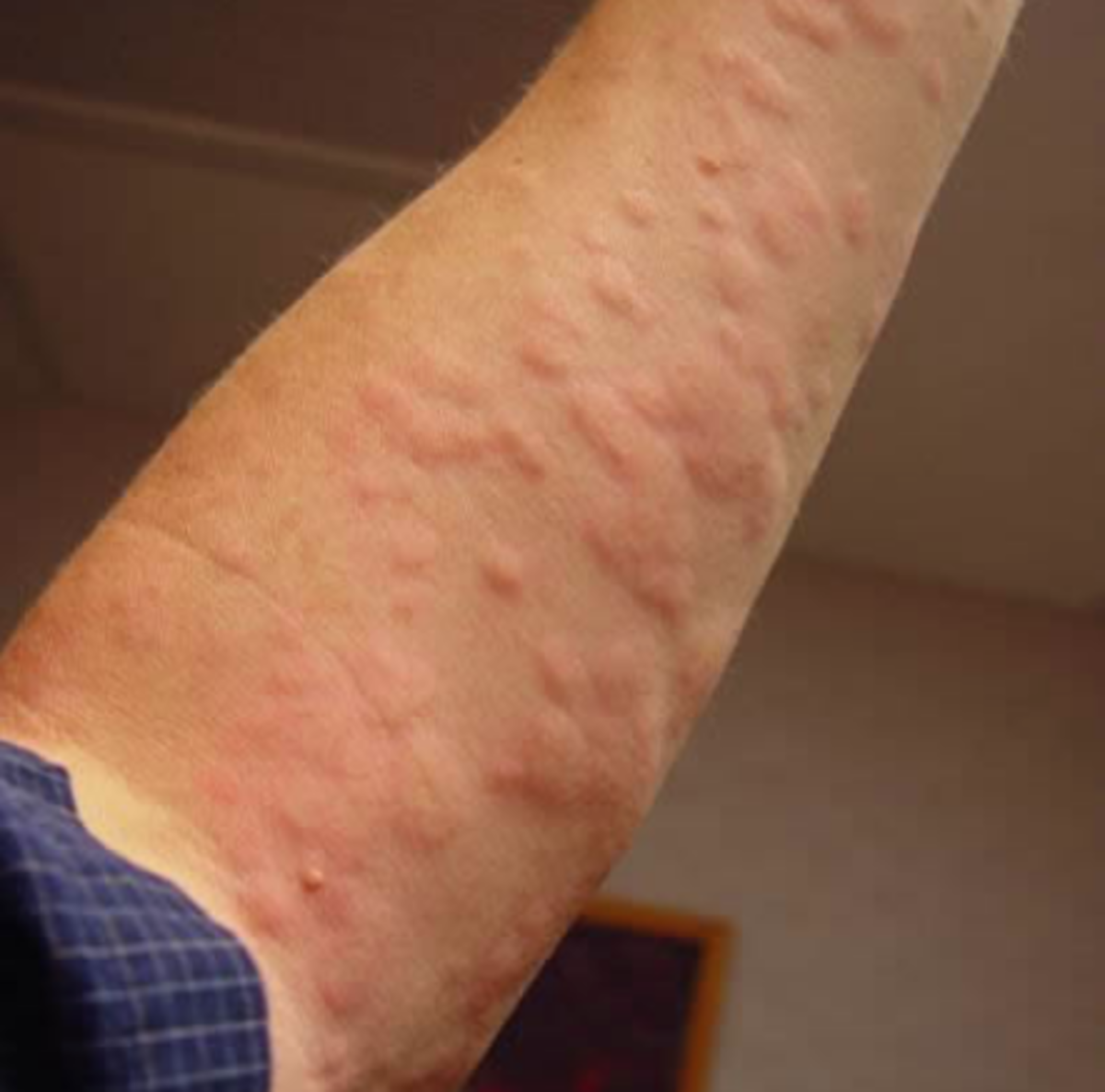Relief From Hives (Urticaria) and Eczema Rashes In Under One Minute ...