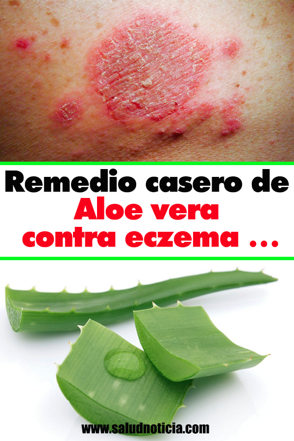 Remedio casero de Aloe vera contra eczema