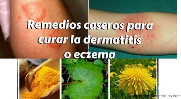 remedios caseros para el eczema onettechnologiesindia com