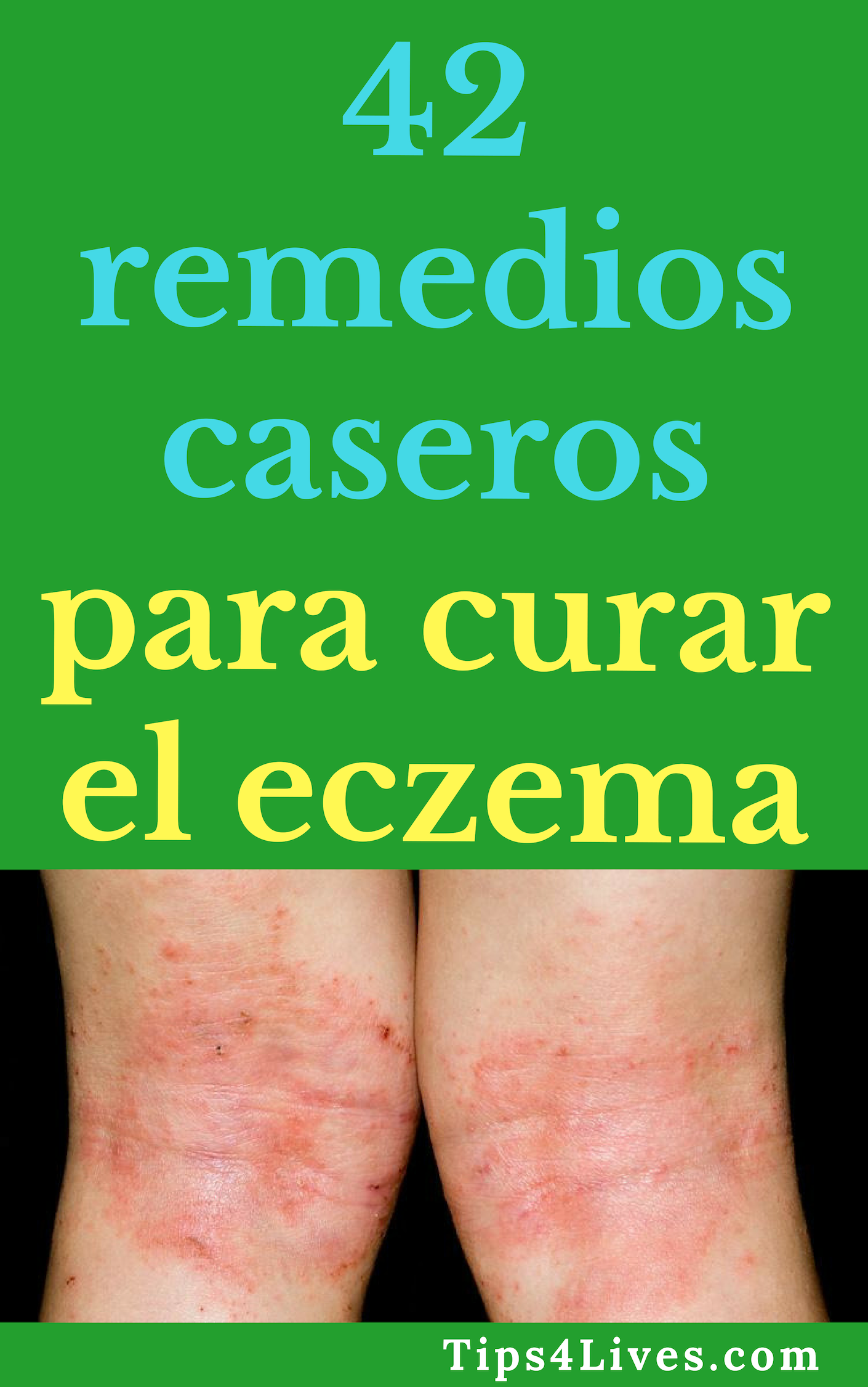 remedios caseros para el eczema onettechnologiesindia com