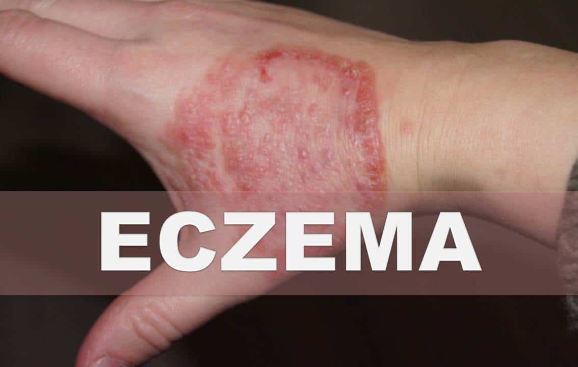 Remedios caseros para la eczema  Como aliviar la piel seca, escamosa e ...
