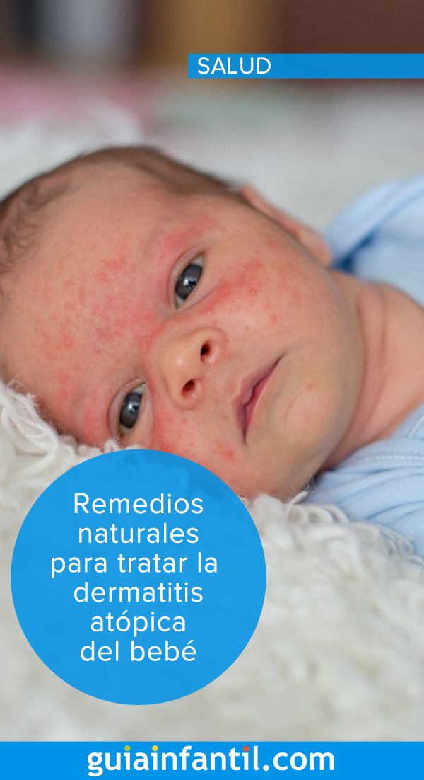 Remedios naturales para tratar la dermatitis atÃ³pica del ...