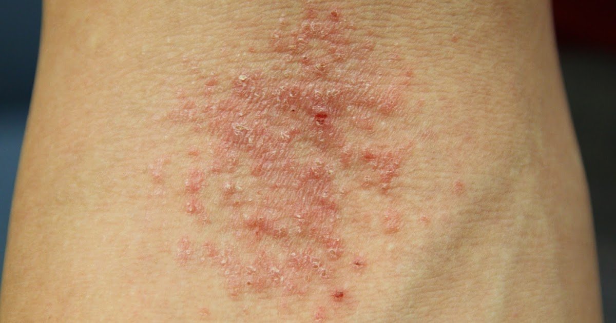 ReshapeLife: Eczema: The Itch That Keeps On Itching