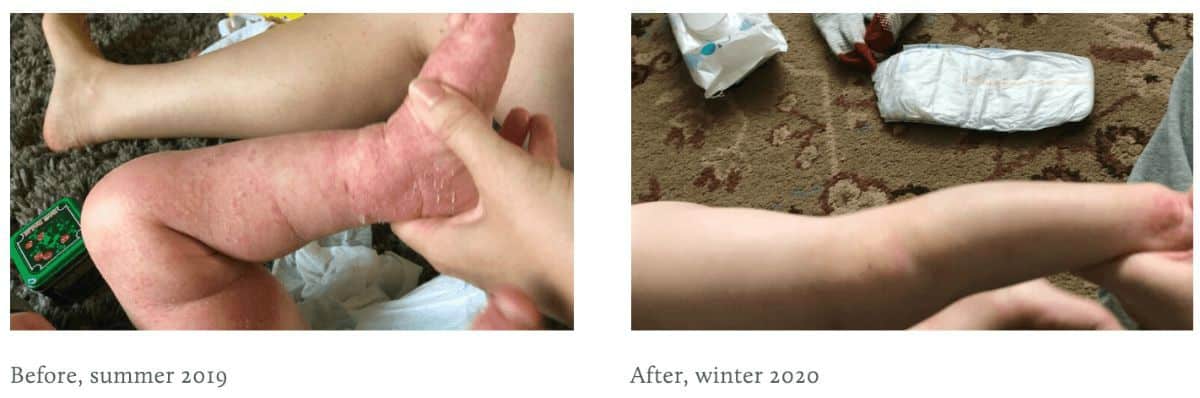 Root Cause of Eczema (and food allergies and sensitivities) is Gut ...