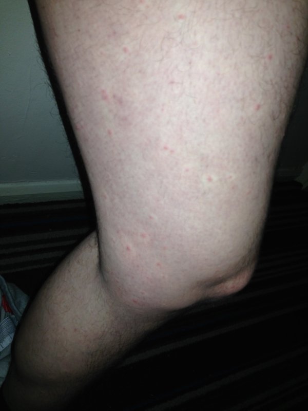 Scabies or post scabies? Very itchy rash.