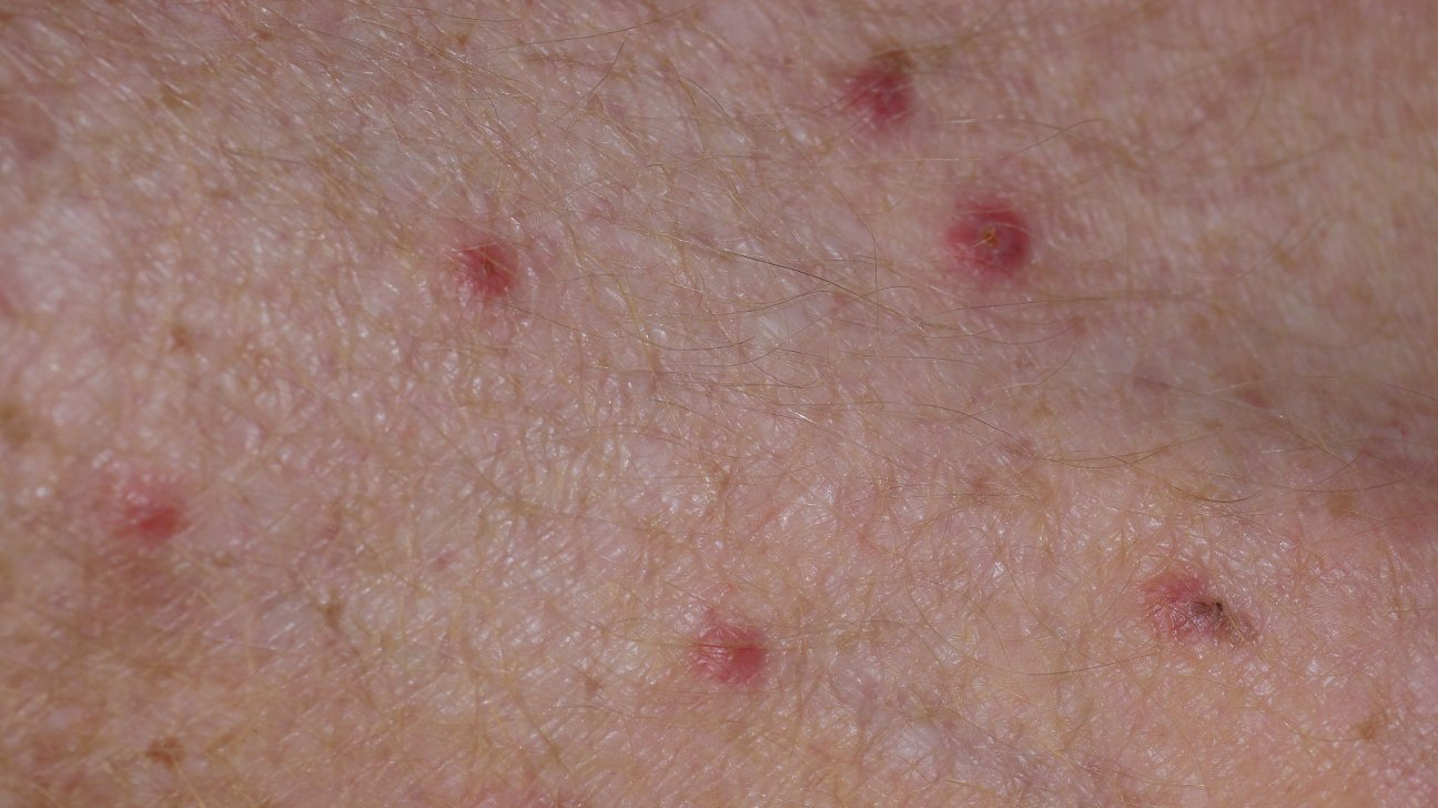 Scabies Vs. Bed Bugs: Identification and Treatment