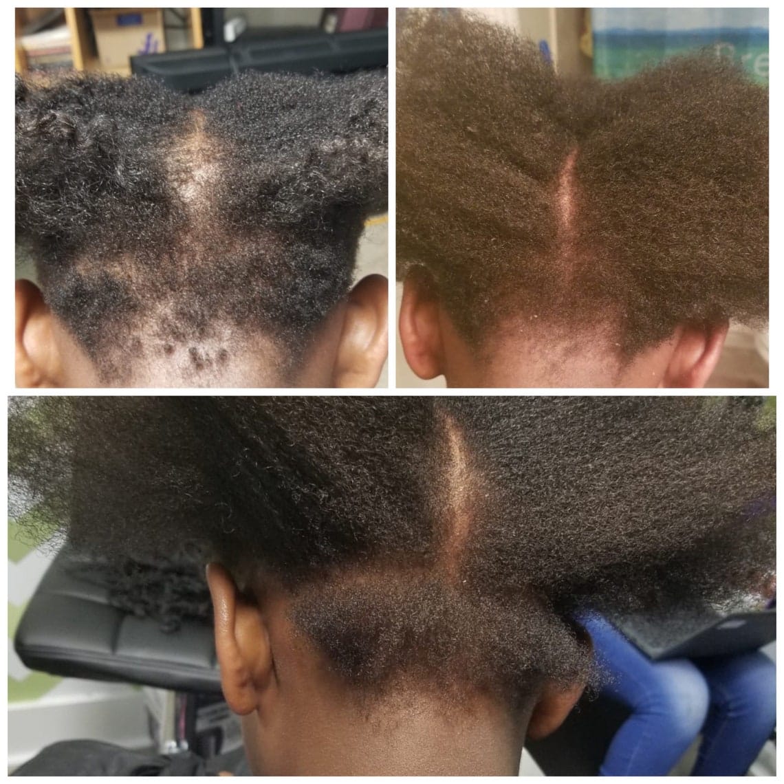 Scalp Care &  hair growth Oil. Treats Dermatitis Eczema and
