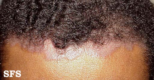 Scalp Psoriasis and Similar Head Rashes â Pictures ...