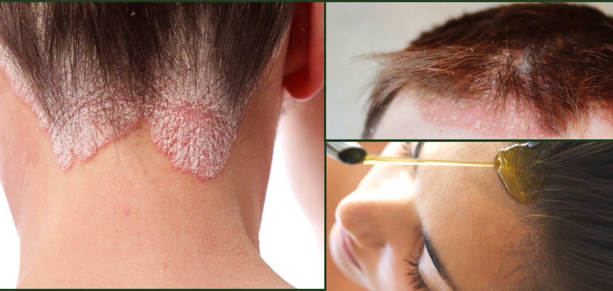 Scalp Psoriasis what is it? What is the Scalp Psoriasis ...