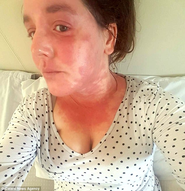 Scottish mother says inhaling cannabis oil cured her eczema