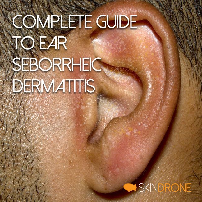 Seborrheic Dermatitis Ear Treatment Fundamentals  SkinDrone