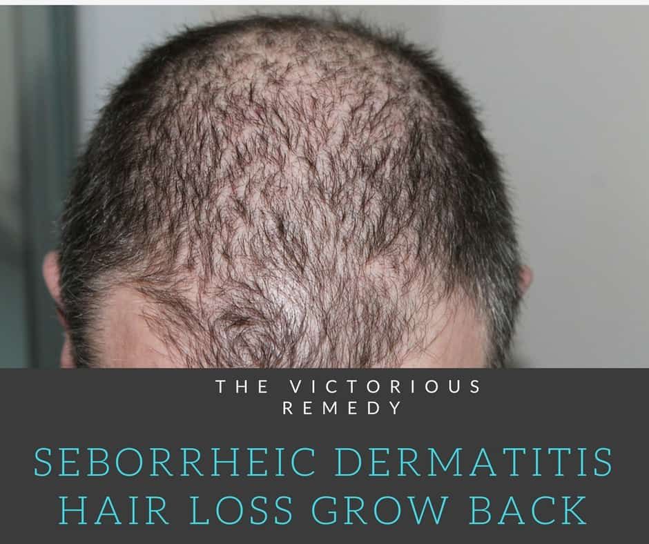Seborrheic Dermatitis Hair Loss Recovery