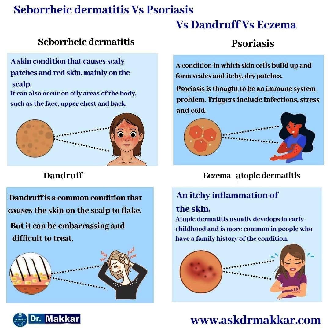 Seborrheic Dermatitis Homeopathic Treatment