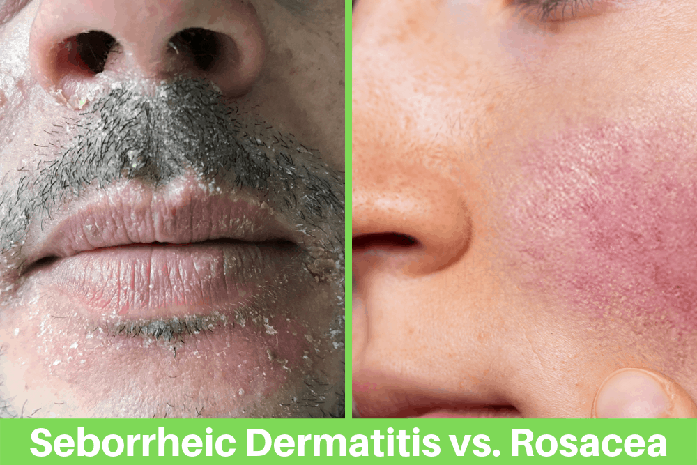 Seborrheic Dermatitis vs Rosacea: Key Differences Between ...