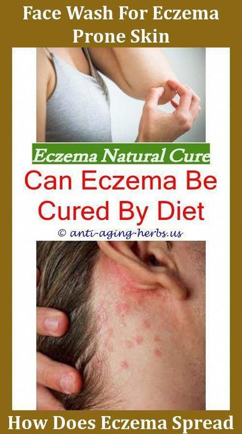 Seborrheic Eczema The Symptoms Of Eczema Eye Eczema Causes Fungal ...