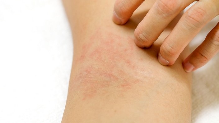 Seven ways to prevent eczema flare