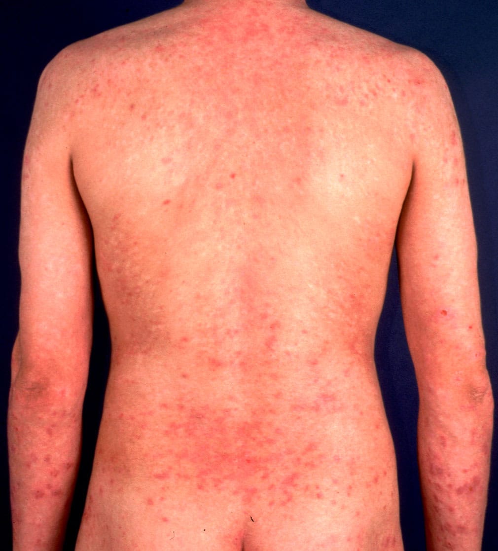 Severe atopic dermatitis and leflunomide: first clinical experience and ...