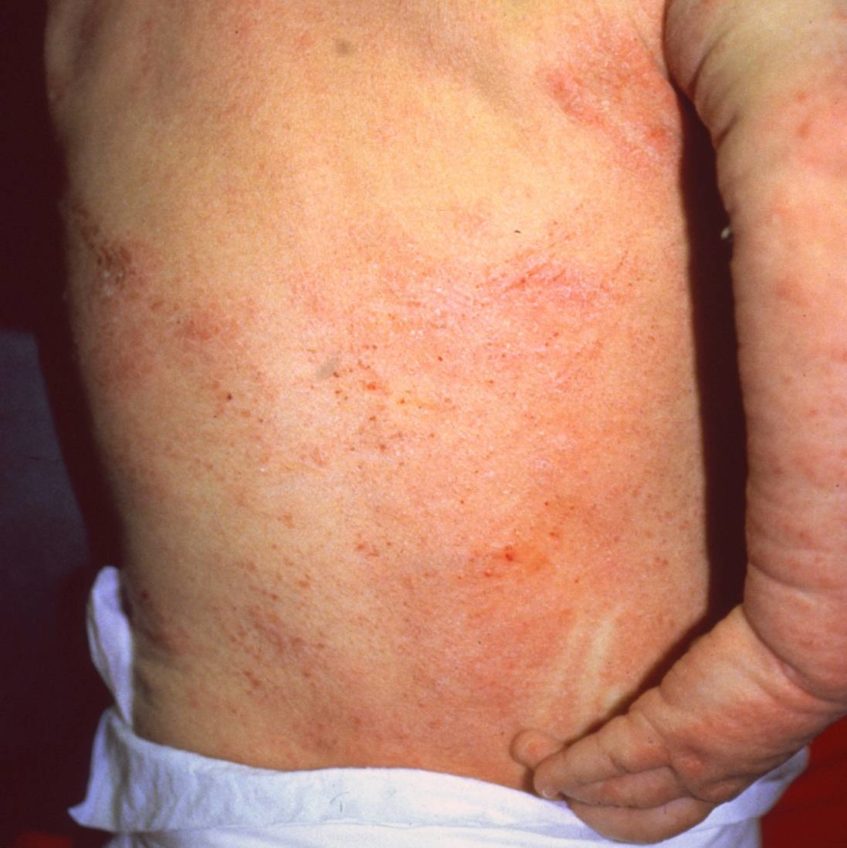 Severe eczema