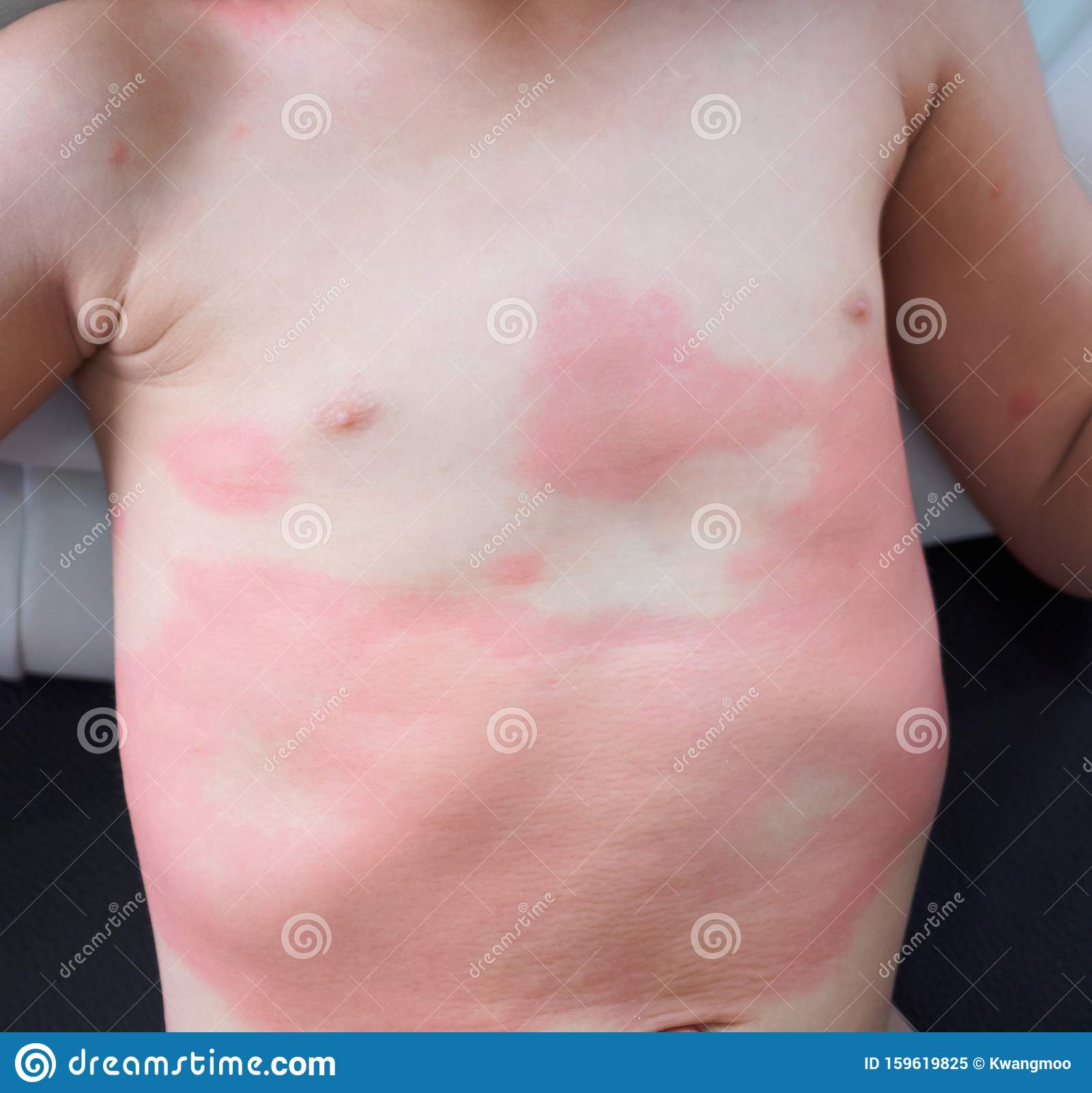Severe Eczema Skin Rash and Allergic Reaction Symtom at Child Body ...