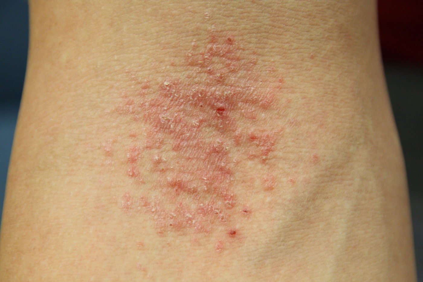 Should I see a Dermatologist or Allergist for My Rash?