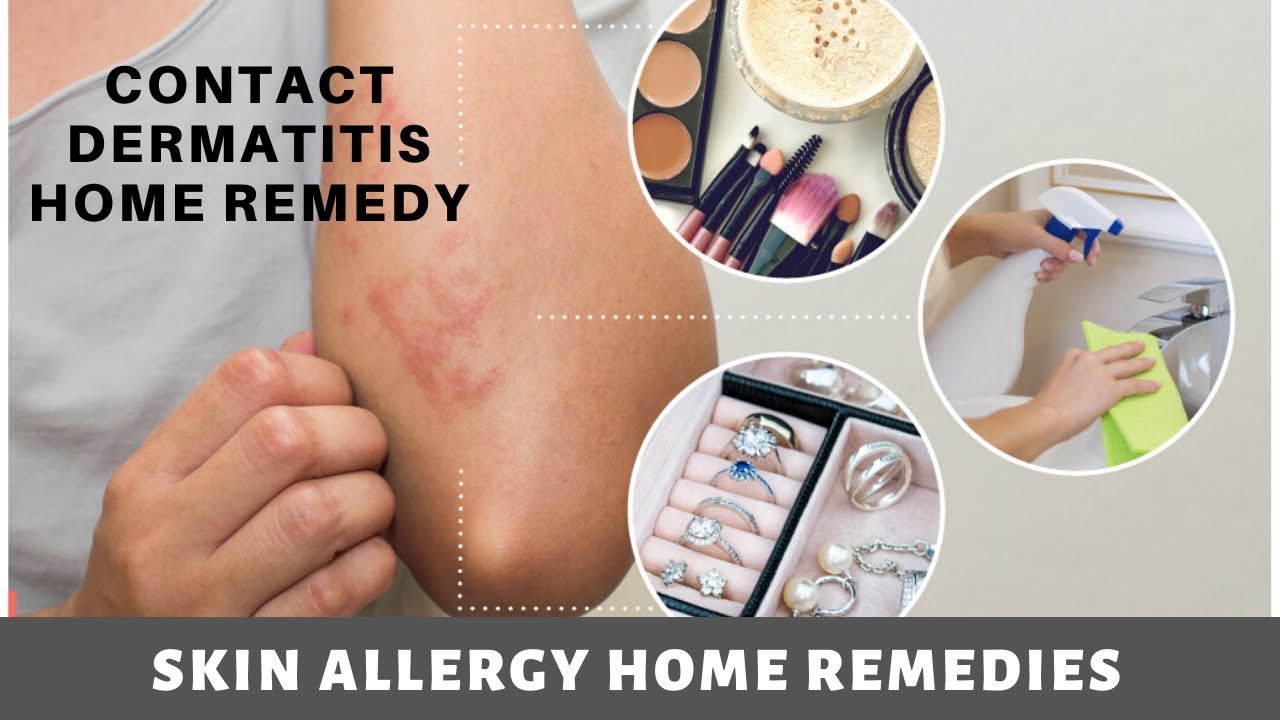 Skin Allergy Home Remedies