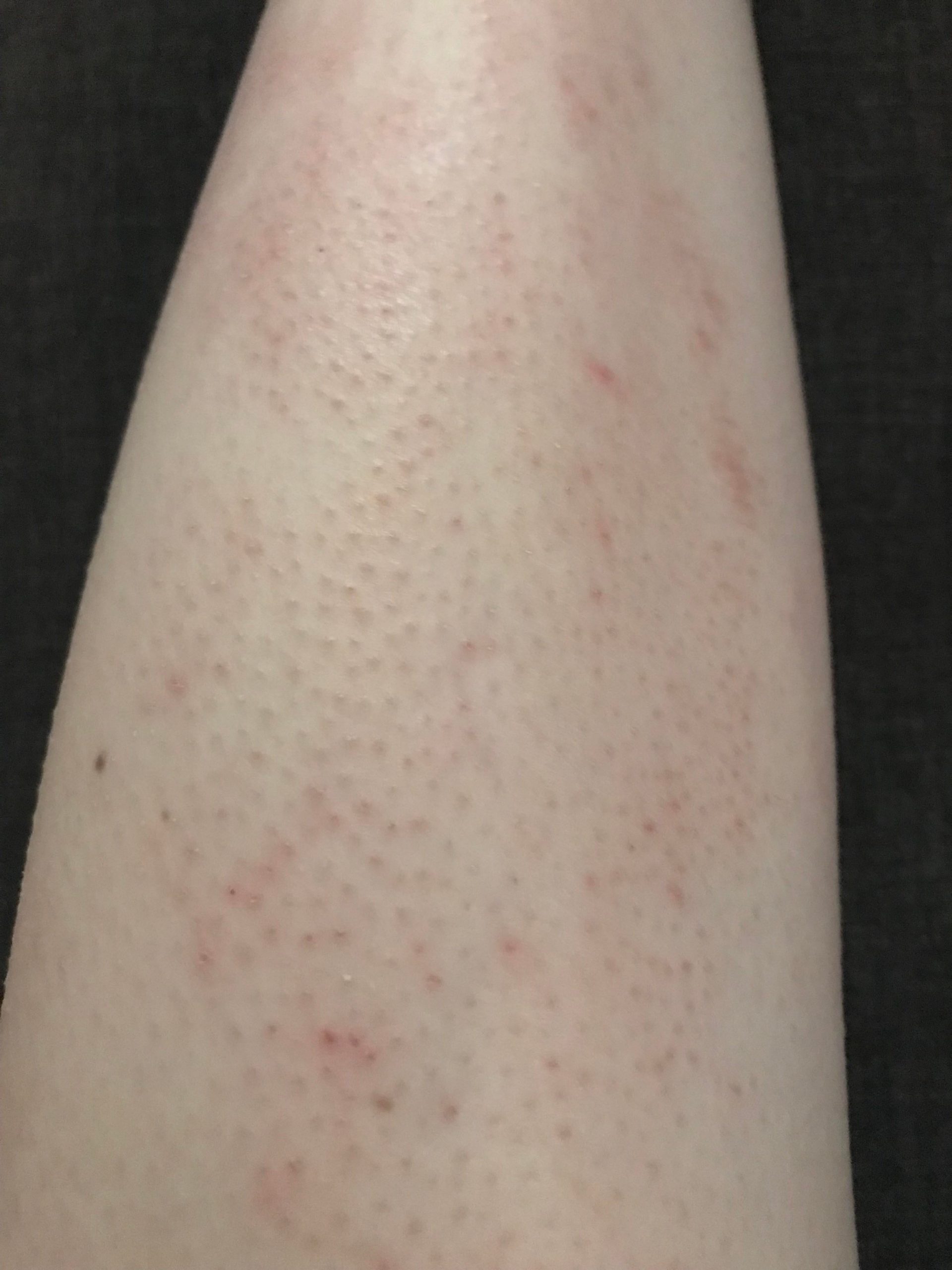 [skin concern] Super itchy skin all over body since September  worse on ...