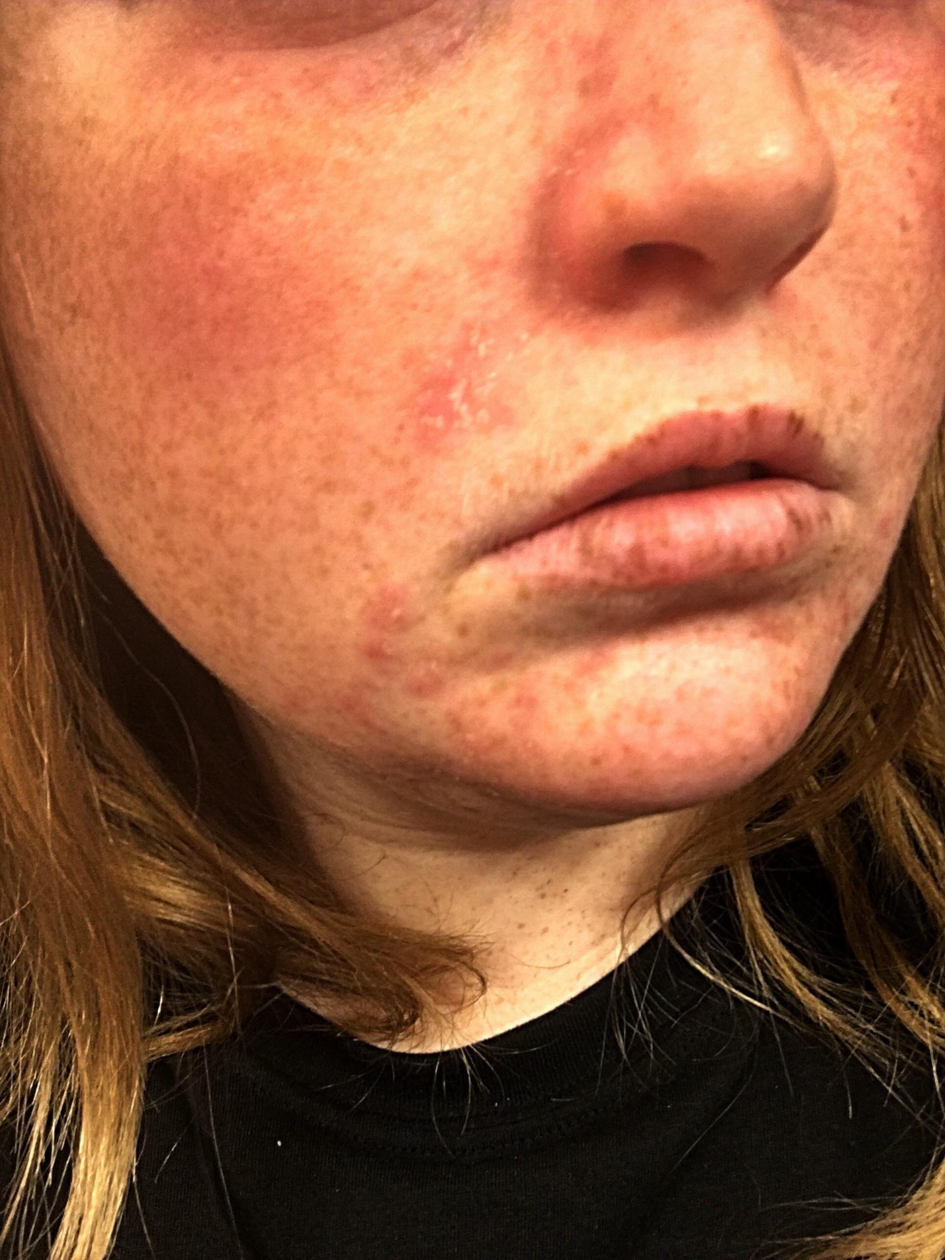 [Skin Concerns] Eczema on my face, please help! Routine in comments ...