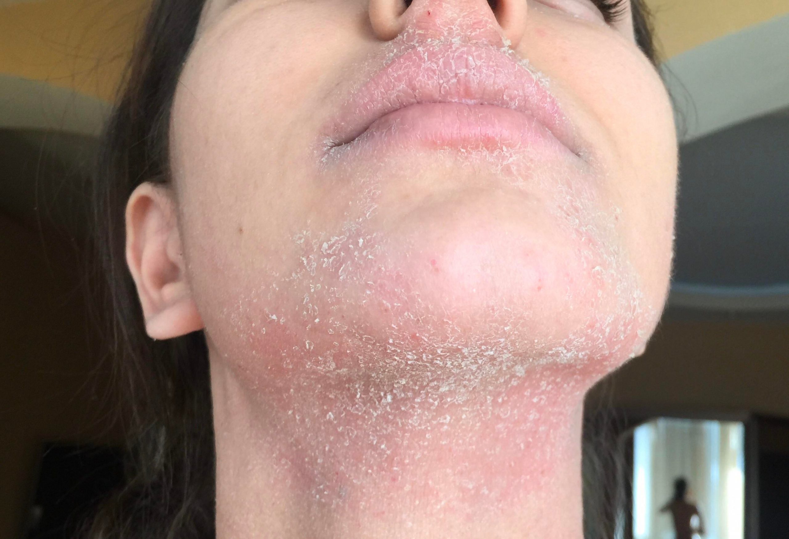 [Skin concerns] They say its an eczema awareness day, so shoutout to ...