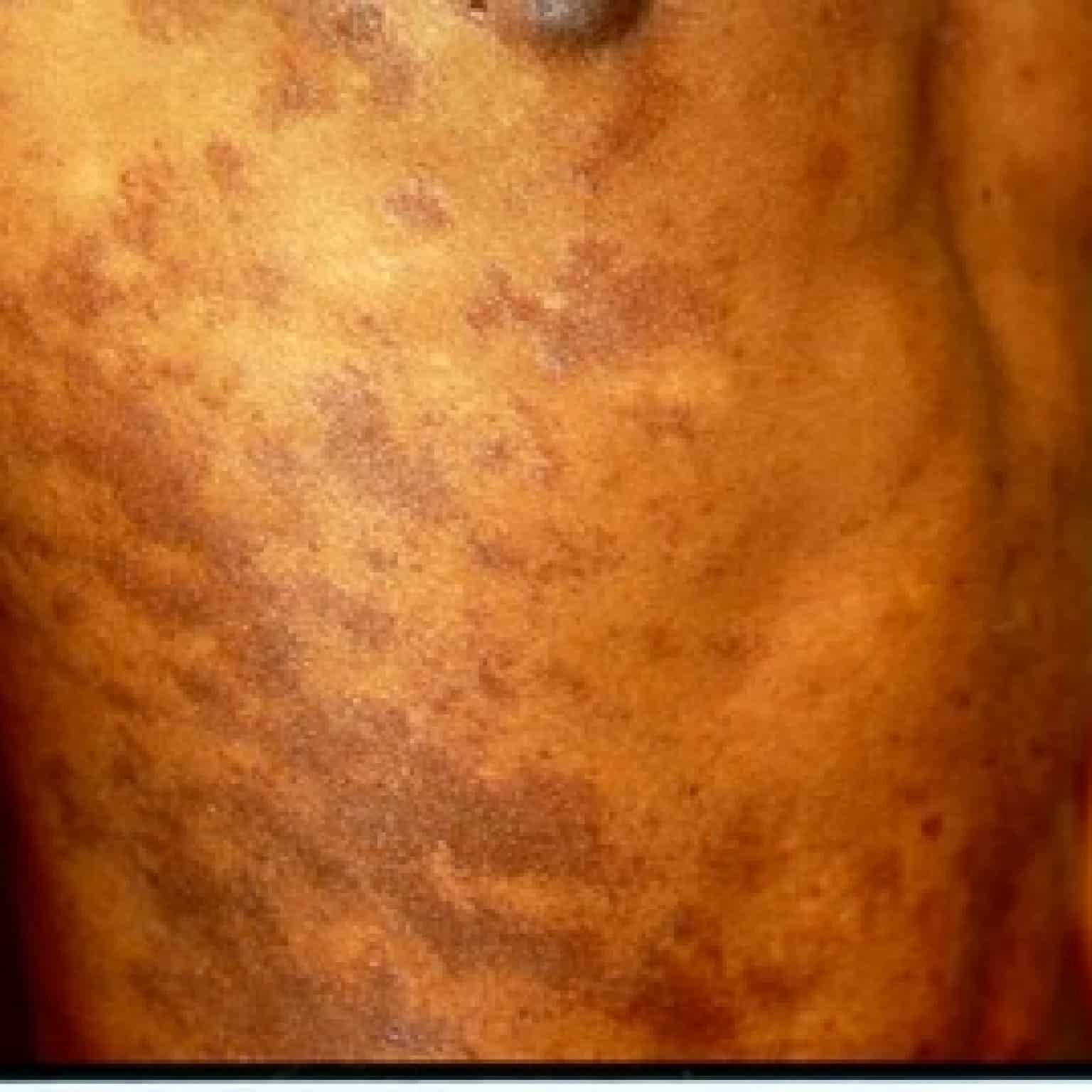 Skin Conditions That Look Like Eczema