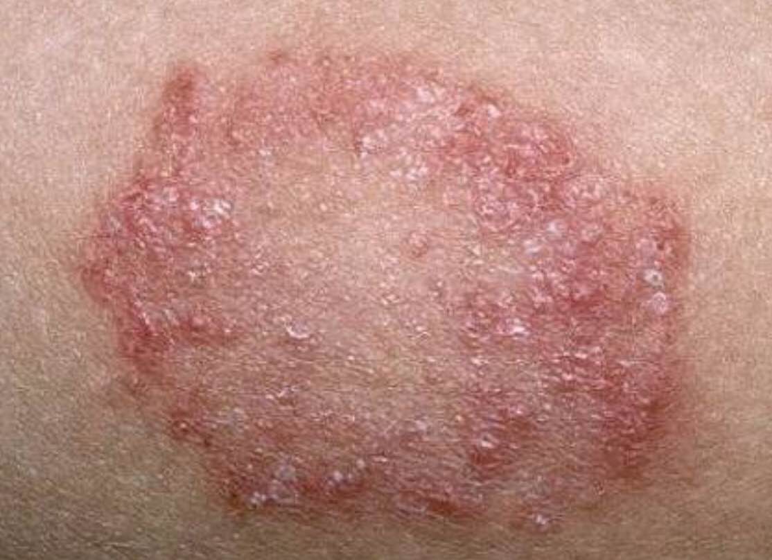 Skin disease or Eczema