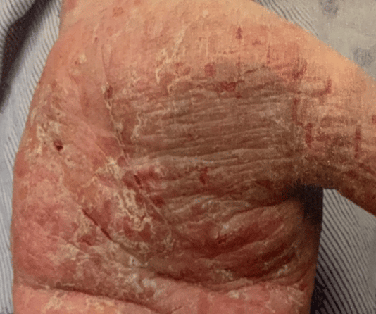 Skin Rashes Causes, Symptoms and Treatment
