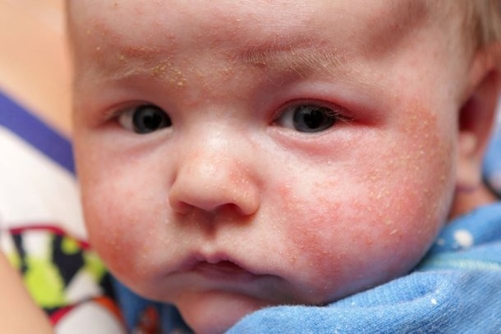 Skin Rashes in Babies: A Concern or Comfort?