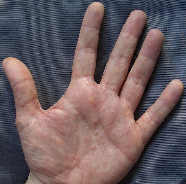 Small Itchy Bumps on Hands and Feet: Causes, Treatments, and Home ...